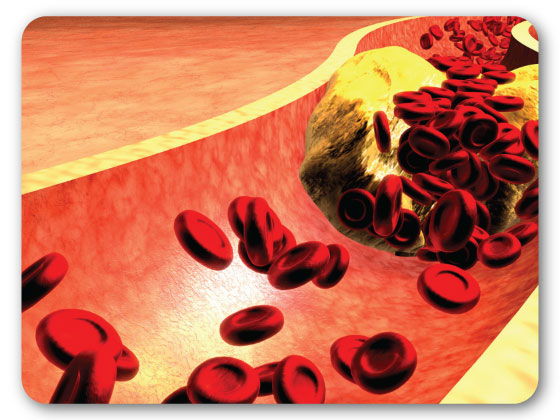 best-high-cholesterol-treatment-in-Habsiguda